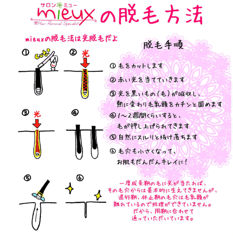 ミューの脱毛方法